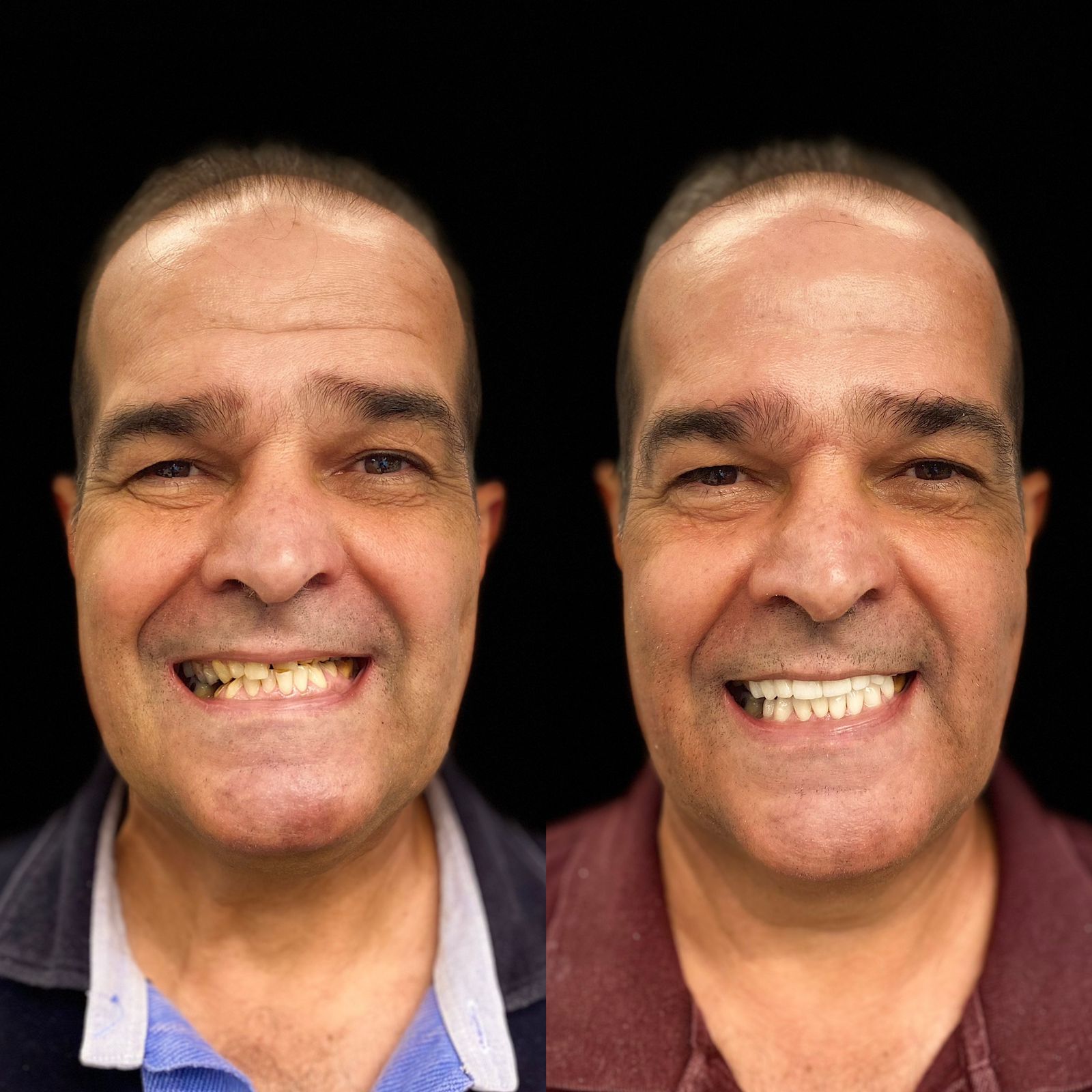 Odonto Premium Imbuí Lentes de Contato Dental #1