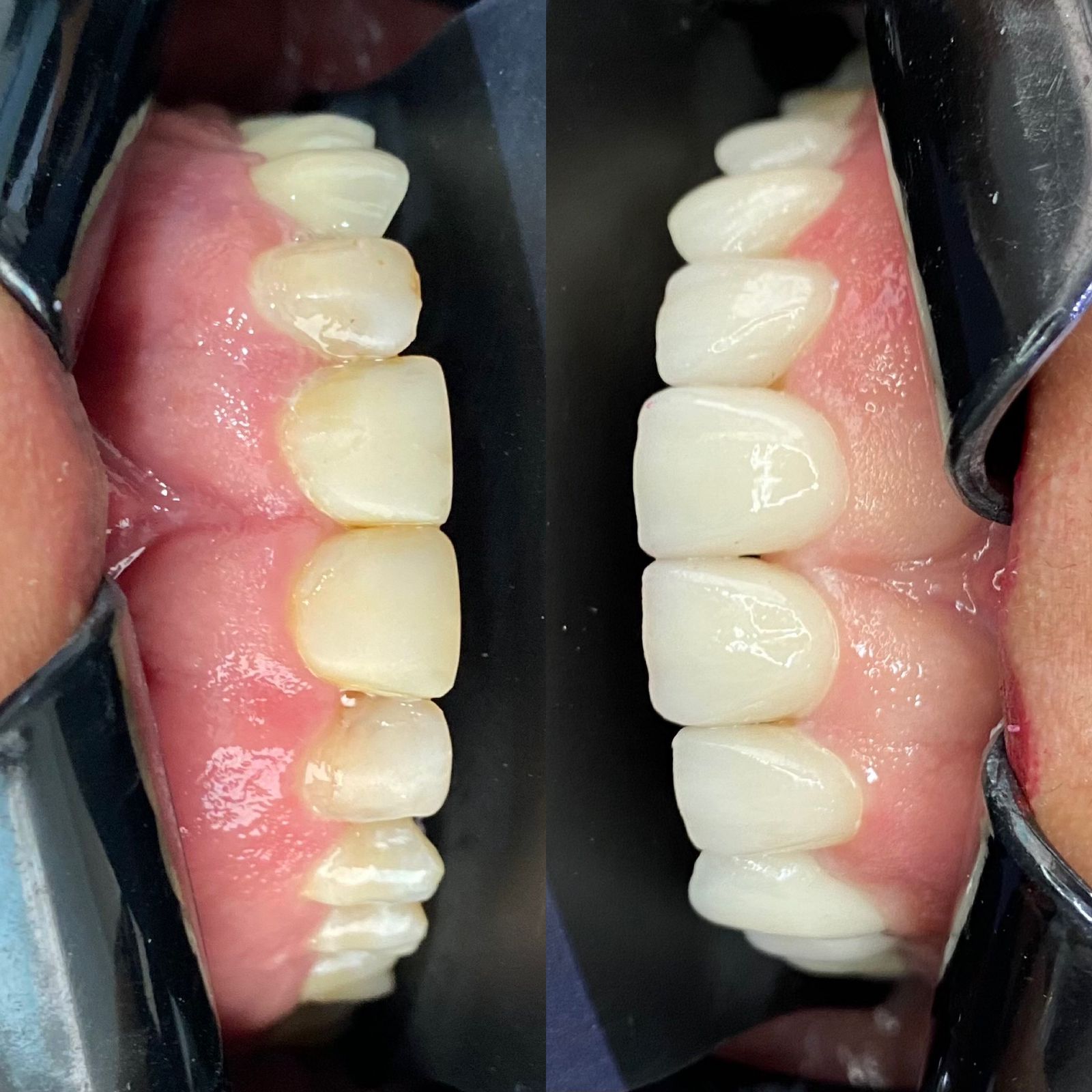 Odonto Premium Imbuí Lentes de Contato Dental #2