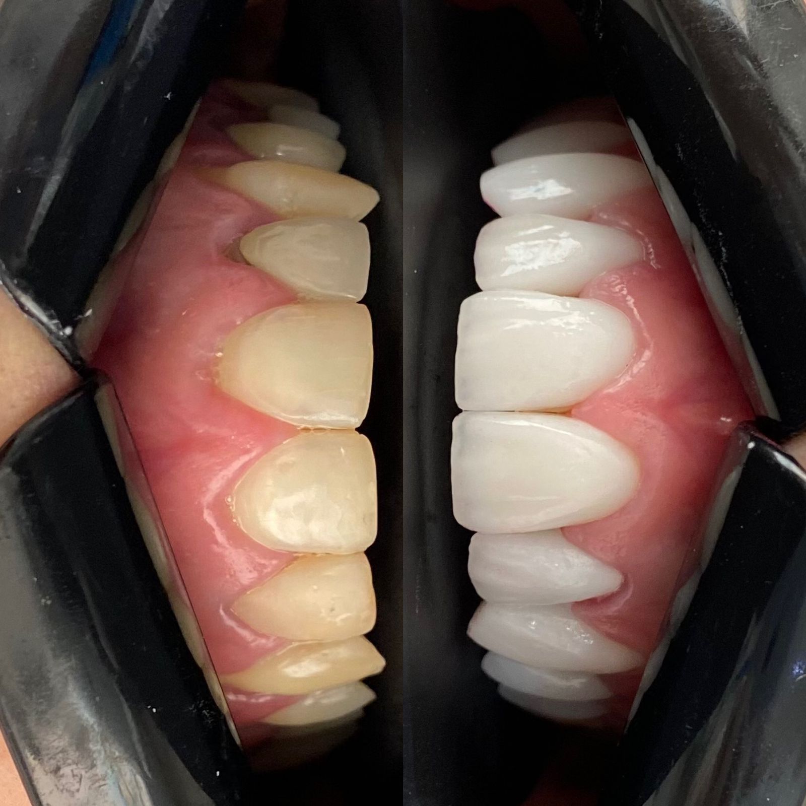 Odonto Premium Imbuí Lentes de Contato Dental #3