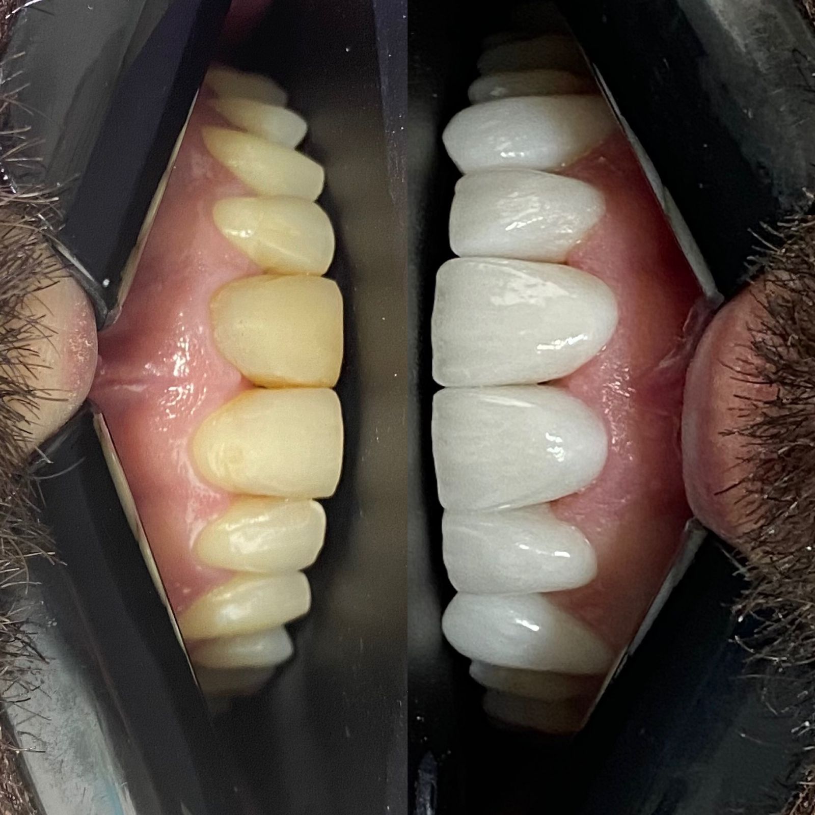 Odonto Premium Imbuí Lentes de Contato Dental #5