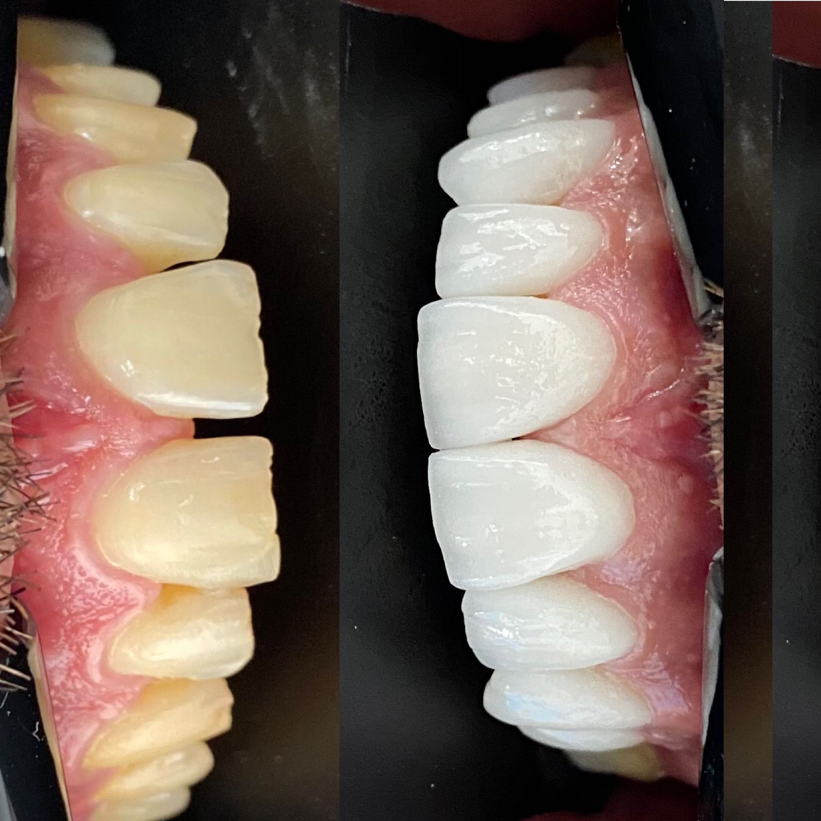 Odonto Premium Imbuí Lentes de Contato Dental #6