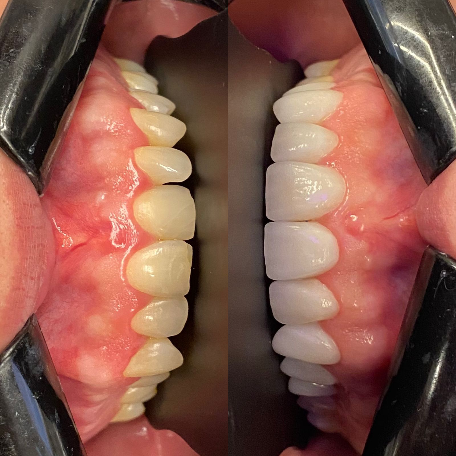 Odonto Premium Imbuí Lentes de Contato Dental #7