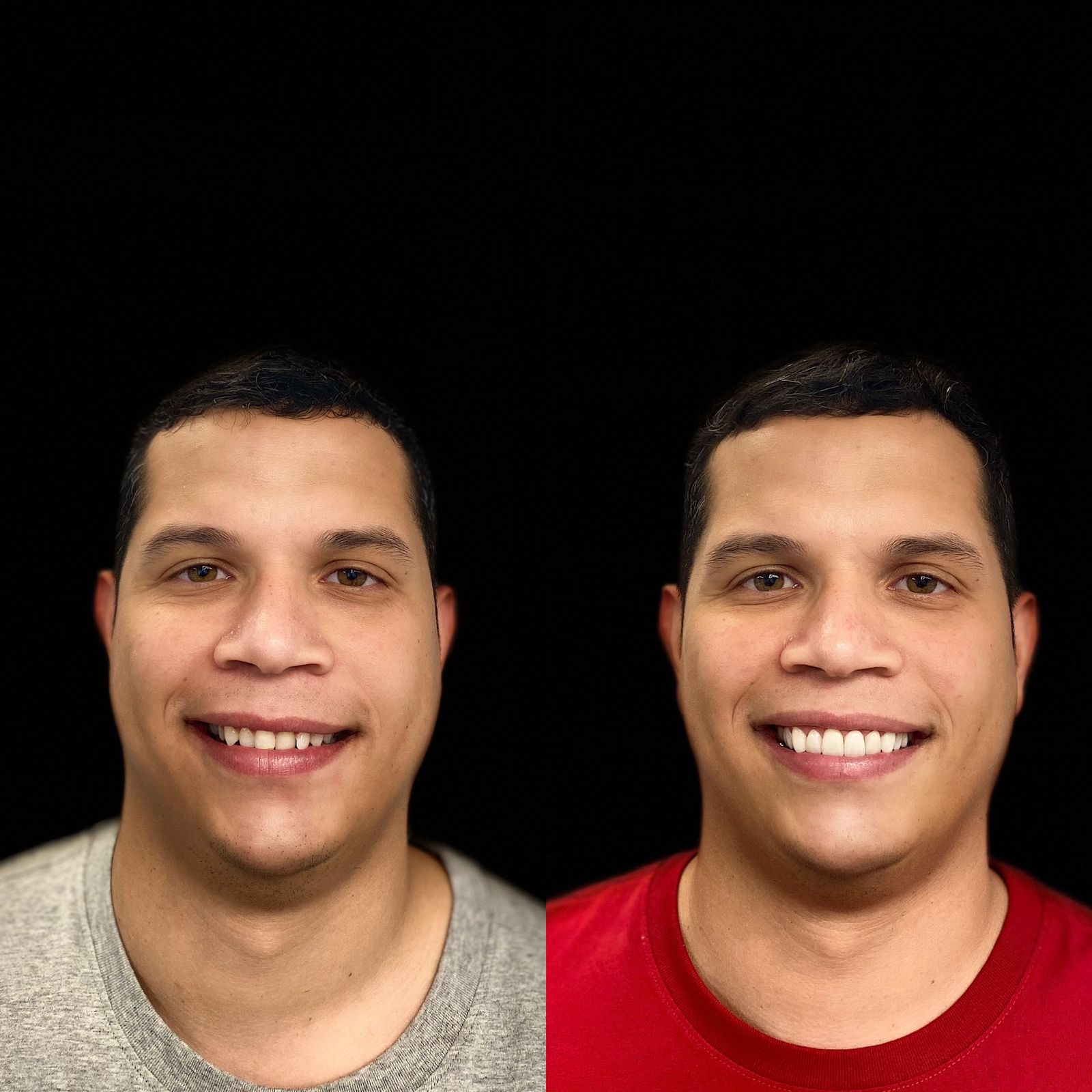 Odonto Premium Imbuí Lentes de Contato Dental #8