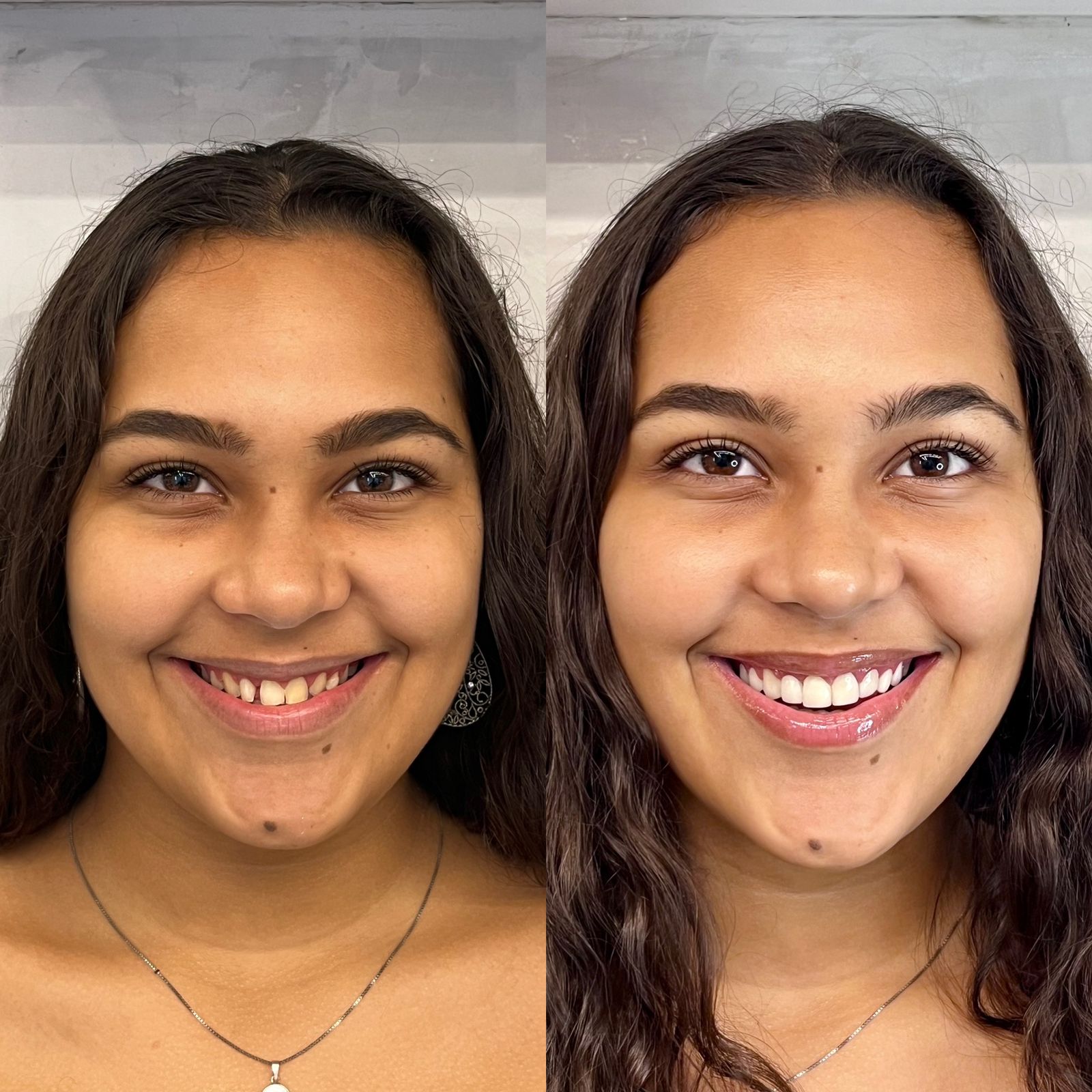 Odonto Premium Imbuí Facetas em Resina #8.1