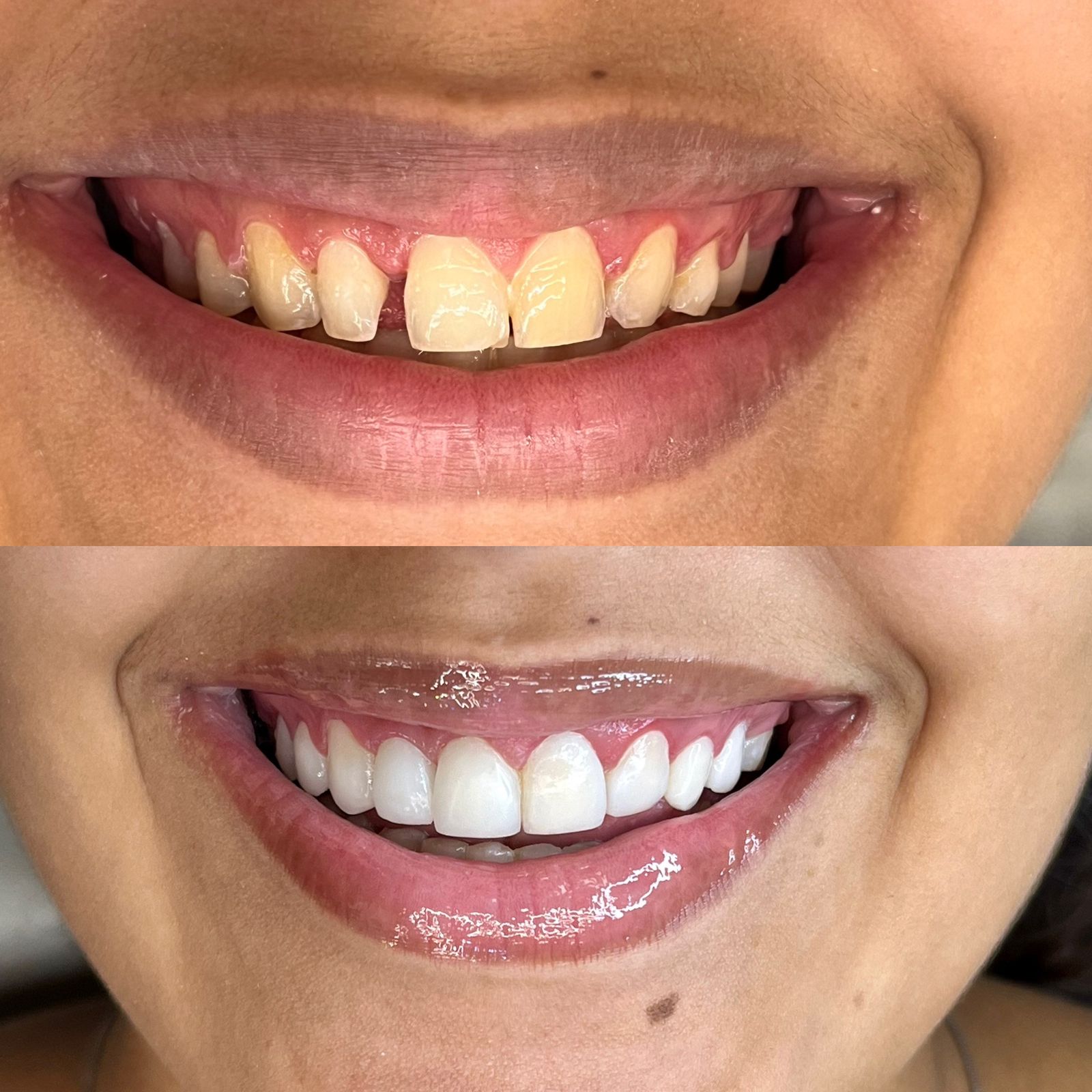 Odonto Premium Imbuí Facetas em Resina #8.2