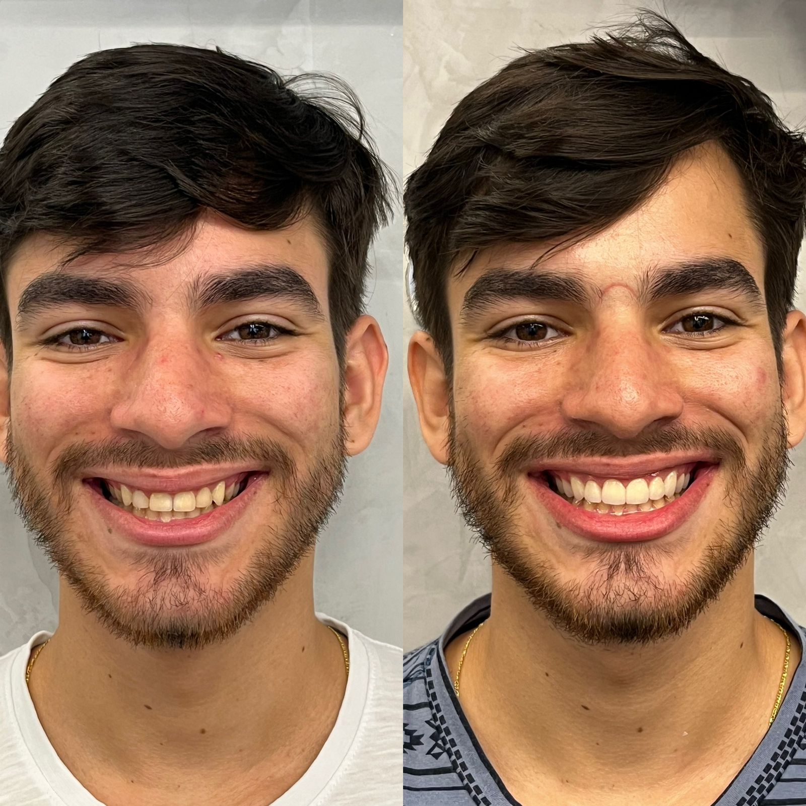 Odonto Premium Imbuí Lentes de Contato Dental #11.1