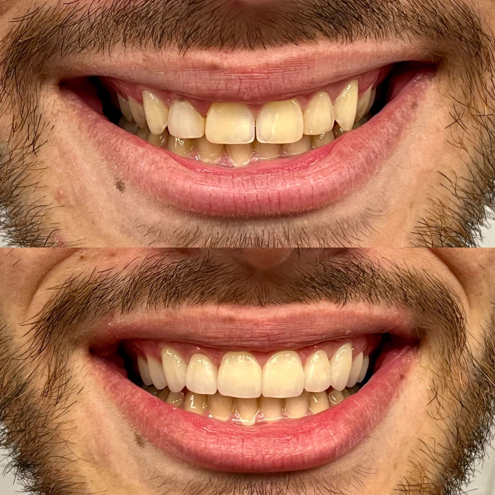 Odonto Premium Imbuí Lentes de Contato Dental #11.2