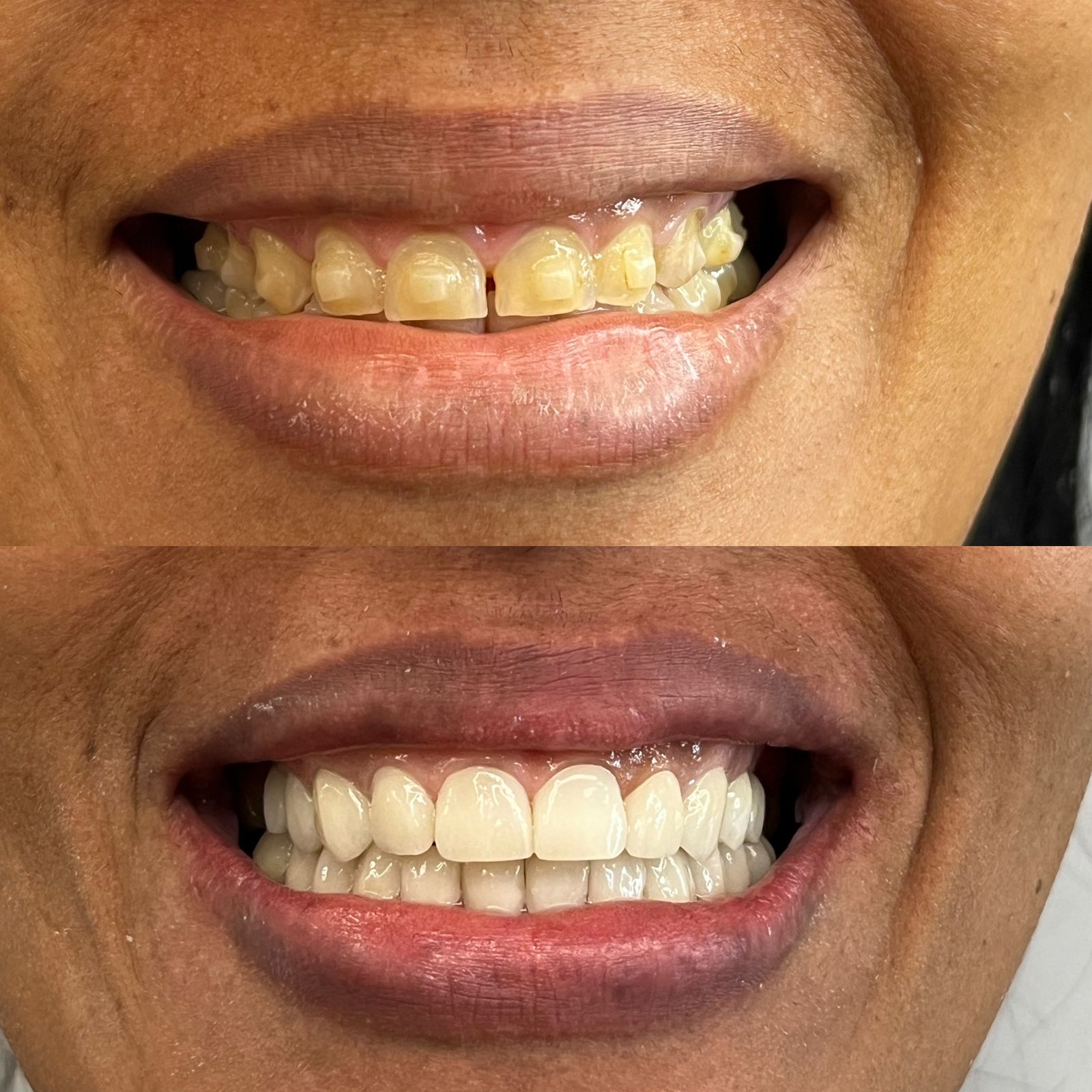 Odonto Premium Imbuí Lentes de Contato Dental #13.2
